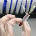 Αιματολογικό
τεστ θα
αποκαλύπτει
πόσα χρόνια θα
ζούμε