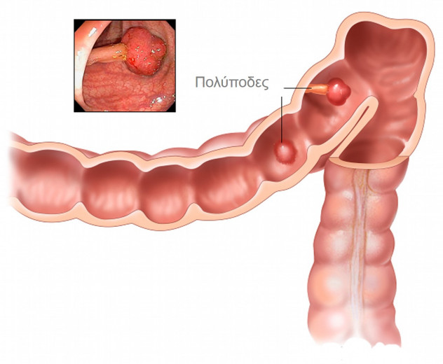 colon-polyps1-632x520
